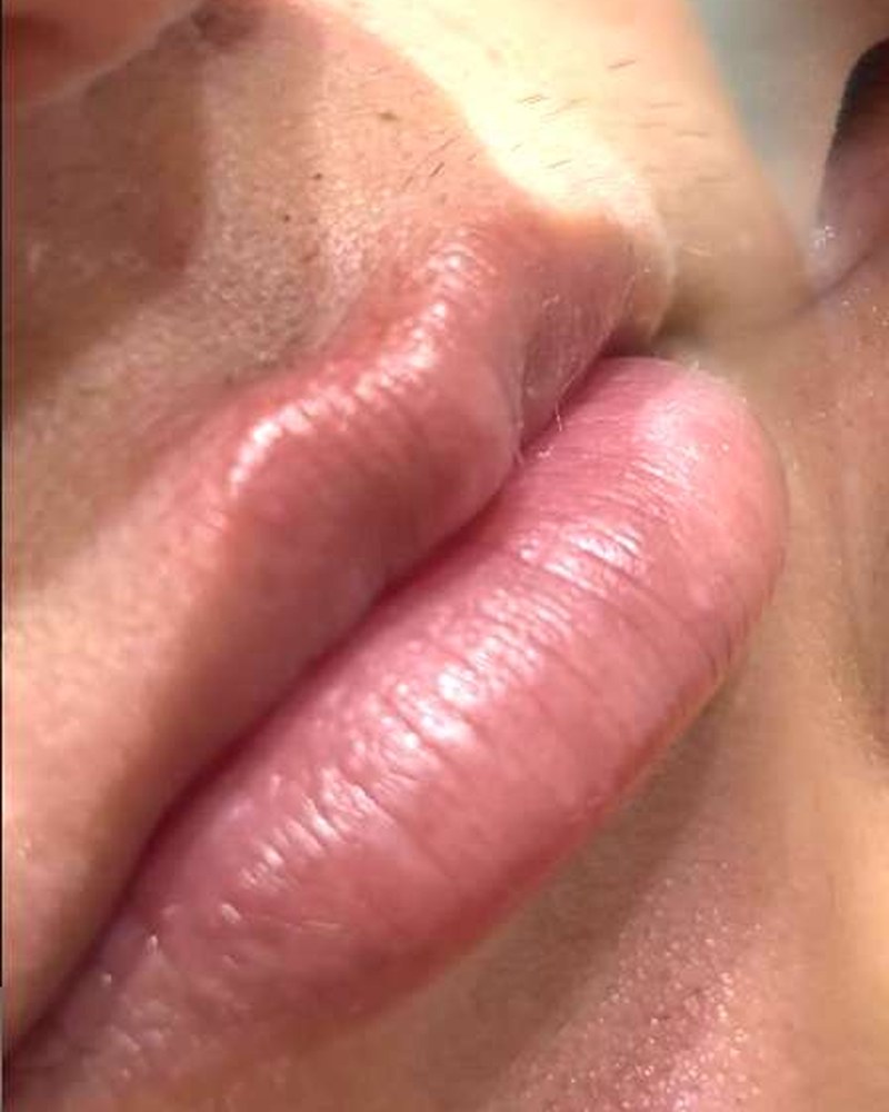 Registro antes de preenchimento labial