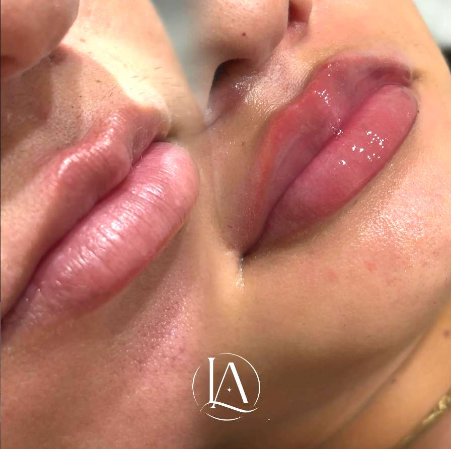 Comparativo de preenchimento labial com registro antes e depois.