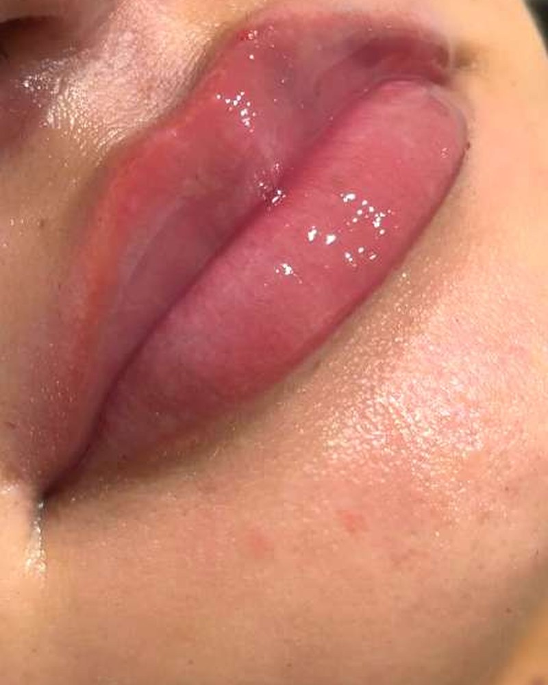 Registro depois de preenchimento labial