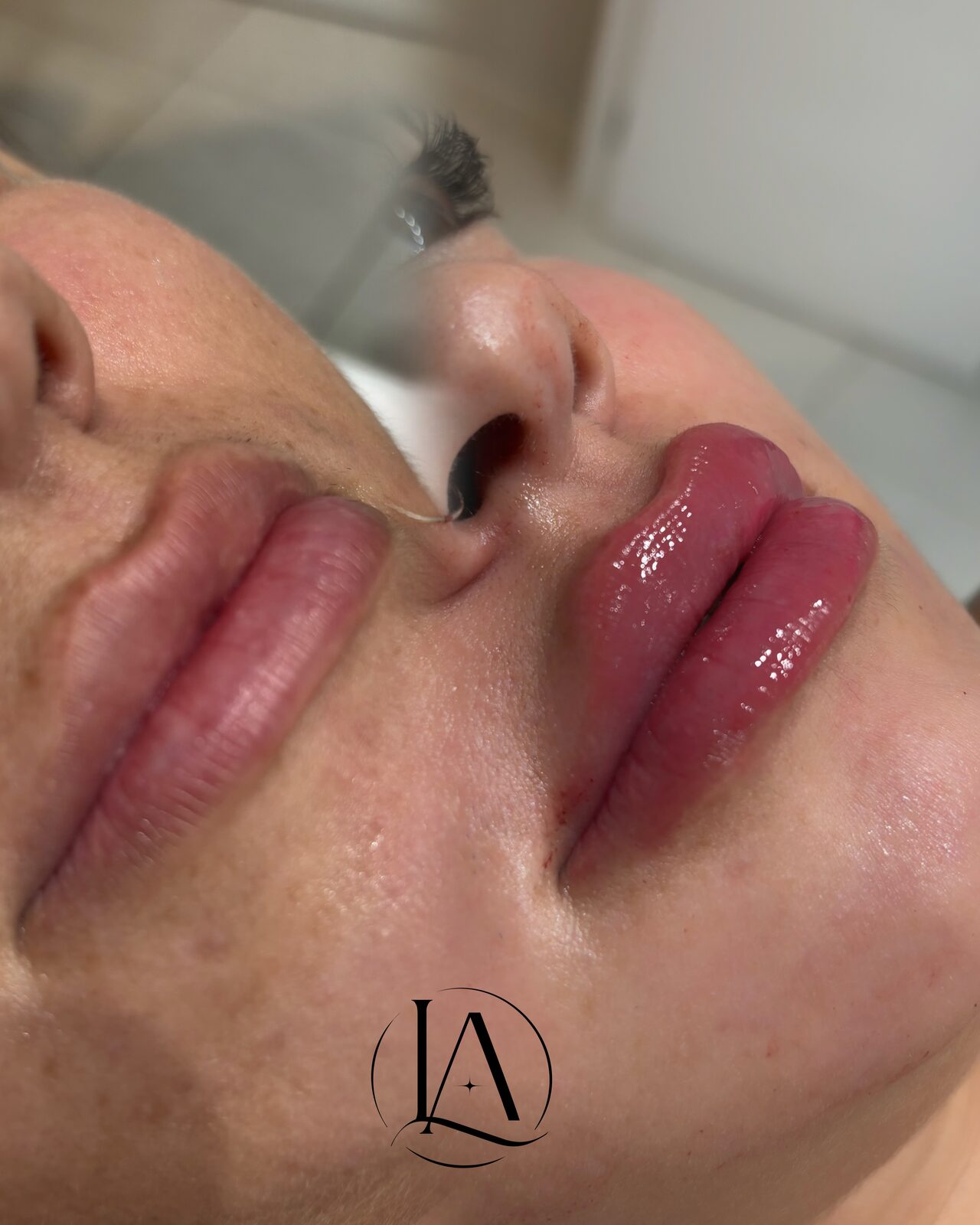 Detalhe de preenchimento labial com naturalidade