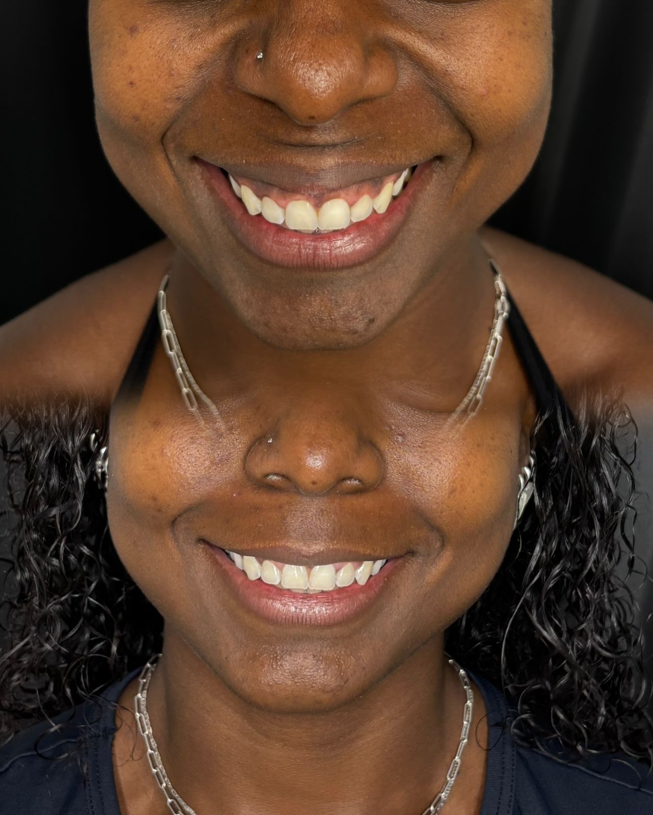 Comparativo de toxina botulínica na região do sorriso e região perioral.
