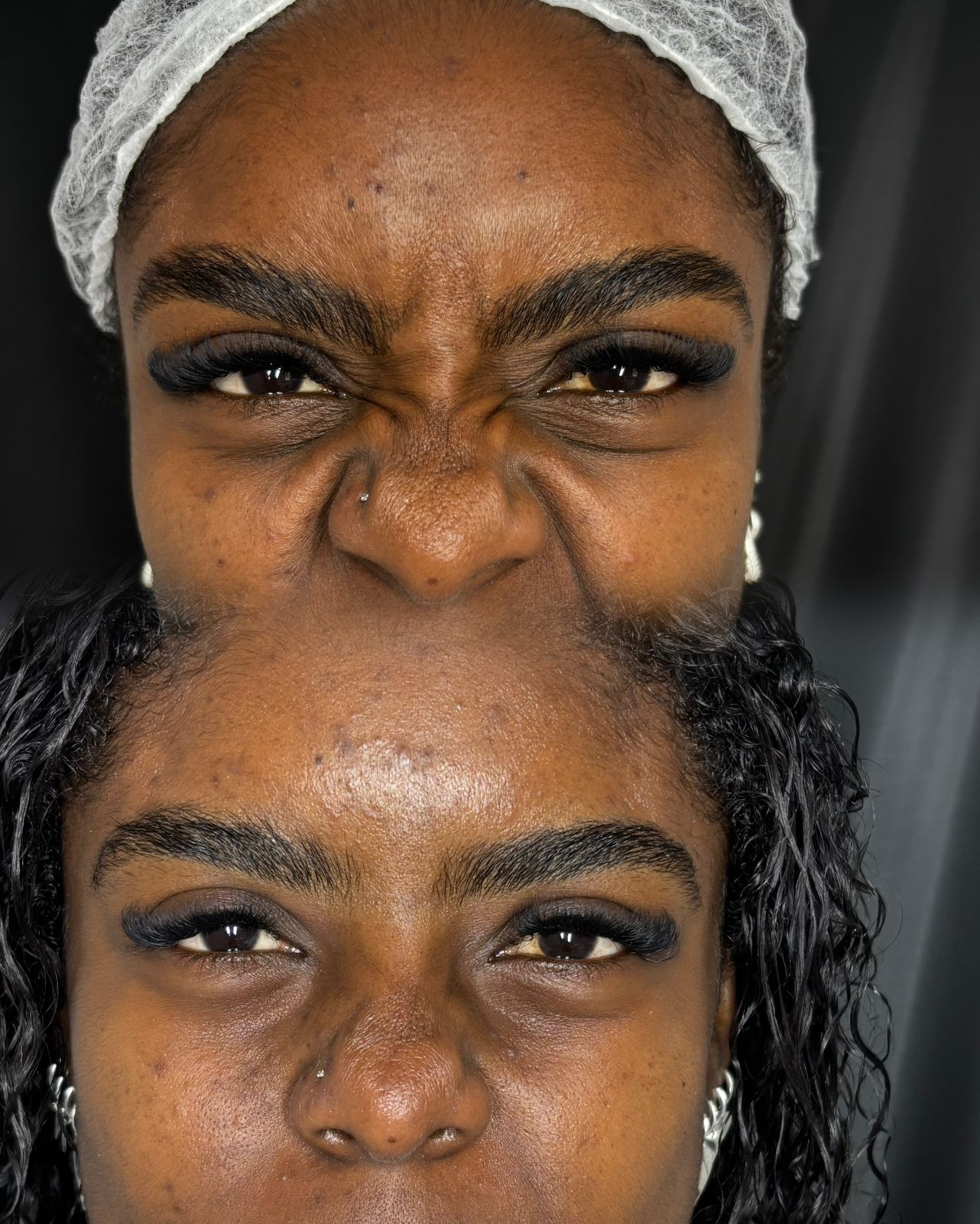 Comparativo de toxina botulínica no terço superior da face durante contração.
